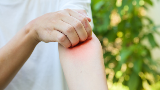 démangeaisons, piqures, insectes, voyage